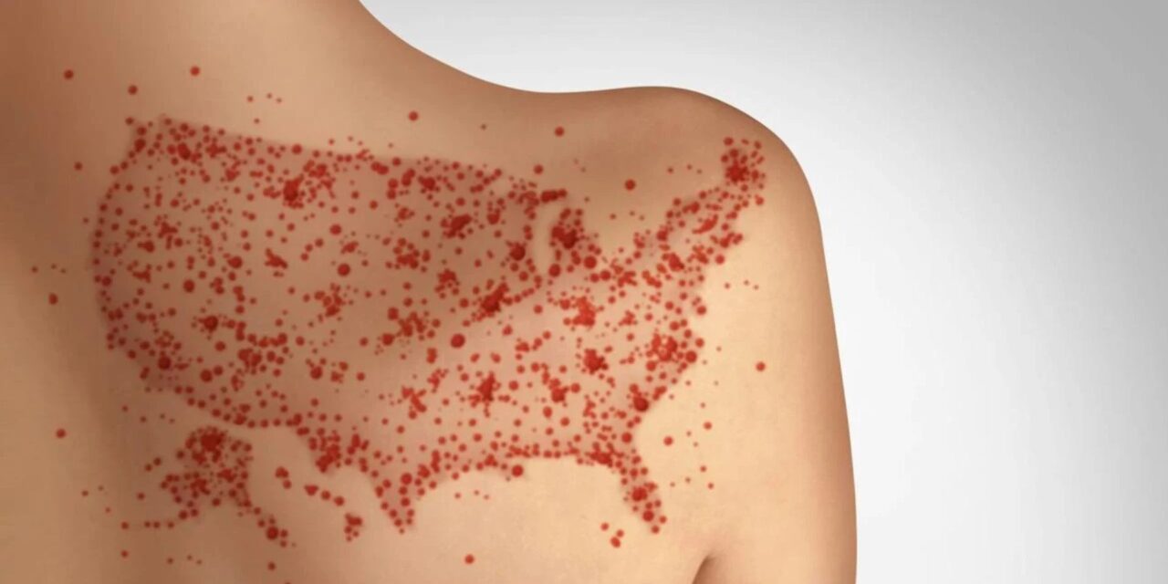 Measles can ravage the immune system and brain, causing long-term damage – a virologist explains