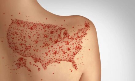Measles can ravage the immune system and brain, causing long-term damage – a virologist explains