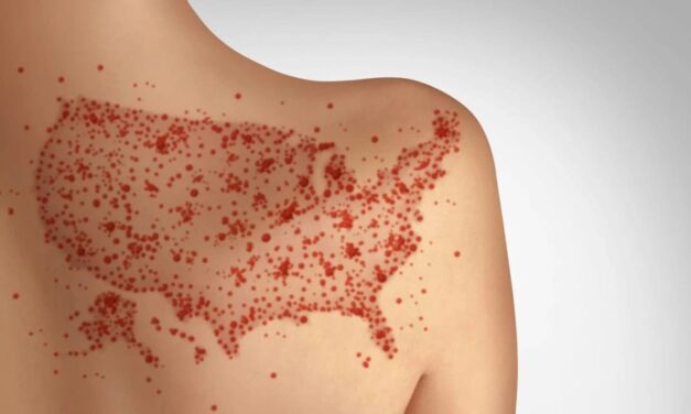 Measles can ravage the immune system and brain, causing long-term damage – a virologist explains